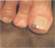 tutore cura unghia incarnita